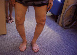 Patient_OA_Knee-1030x773